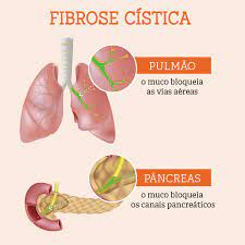 Fibrose Cistica 