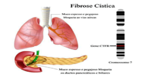 Fibrose Cistica